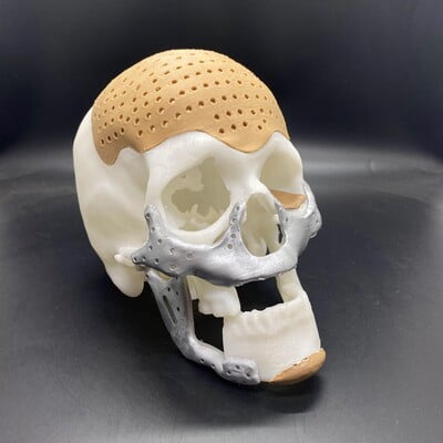 Skull Model with Implants